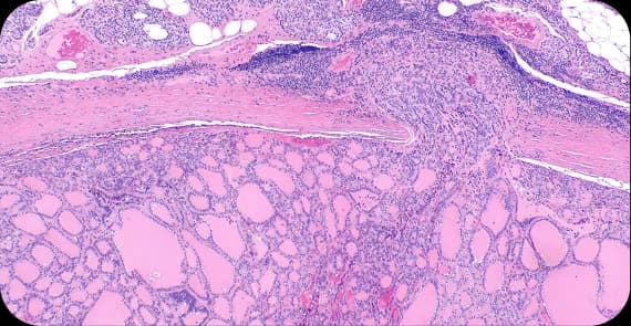Follicular Thyroid Cancer