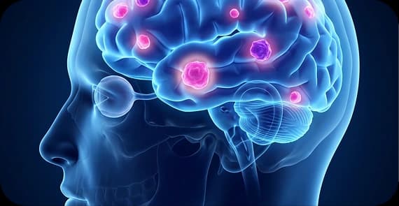 Metastatic Brain Tumours 